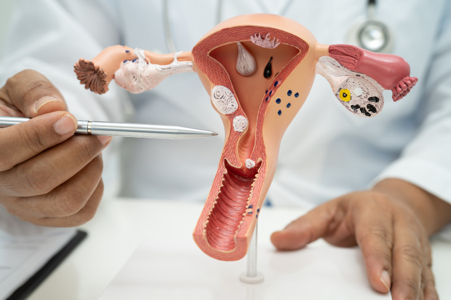 8 Gejala PCOS pada Wanita yang Dapat Memengaruhi Kesuburan 3 bisakah pcos diatasi