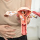 gejala pcos pada wanita